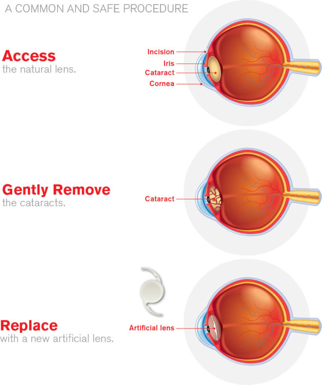 Cataract Surgery Process Image